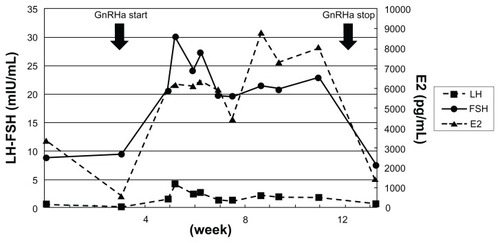 Figure 2 Fluctuation of estradiol (E2) levels after dilatation and curettage. The periodic increase and decrease of the E2 levels are seen in follicle-stimulating hormone (FSH)- secreting adenoma in an approximate a 6-week cycle.