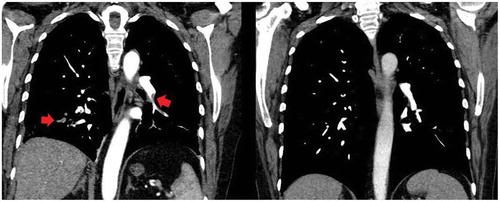 Figure 1. (a) Pulmonary artery thrombosis (red arrows). (b) complete resolution of the thrombosisCTPA documented the complete resolution of the arterial thrombotic lesions in all patients