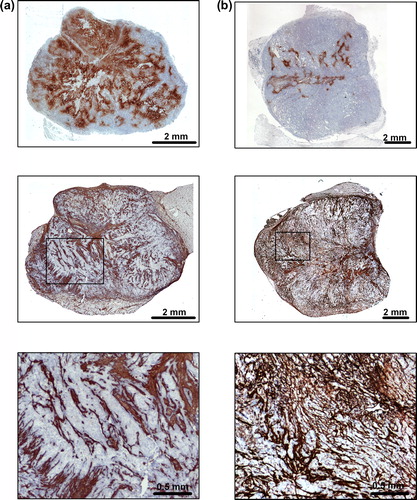 Figure 1. Immunohistochemical preparations of (a) a CK-160 tumor with high HFPim and low CTFCol and (b) a CK-160 tumor with low HFPim and high CTFCol. Upper panels: pimonidazole staining of tumor hypoxia. Middle panels: collagen staining of tumor connective tissue. Lower panels: high magnification images referring to the boxes shown in the middle panels.