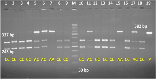 Figure 9. PCR-RFLP pattern at loci 337(C > A) of OLR1 gene amplified by Primer 1 and digested by pst1 enzyme.