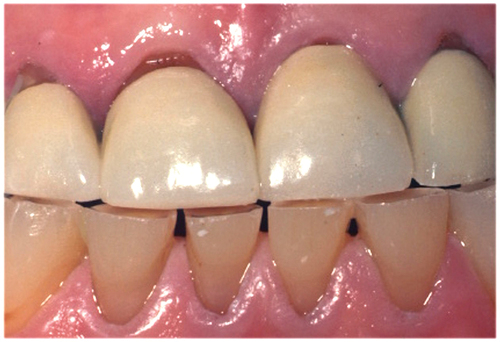 Figure 3. A clinical image demonstrating wear of the natural anterior mandibular dentition opposing feldspathic porcelain crowns.