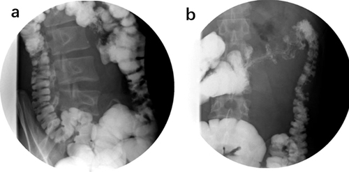 Figure 6 (a and b) Barium enema angiogram indicates revealing sustained contractions and spasms in the transverse colon and left portion of the colon (including the splenic flexure and descending colon).