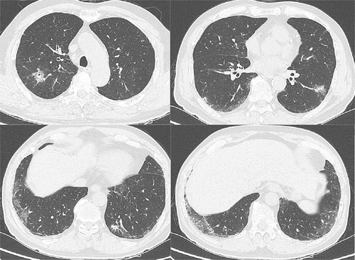 Figure 5 CT Chest on May 9th, 2023 (further improvement of the inflammatory lesions, more reduction in cavitary and interstitial changes compared with CT Chest on April 27th, 2023).