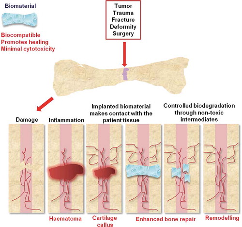 Figure 1. Stages of biomaterial-mediated bone repair. Bone defects can originate from a variety of causes (outlined). Natural or synthetic scaffolds (hydrogels in this example) can aid bone repair. These biomaterials possess osteoconductivity, biodegradability, controlled growth factor release, and cell encapsulation and can be produced from a range of composite materials including metals, ceramics, or polymers. Vascularization is vital to biomaterial design since impaired revascularization delays bone healing