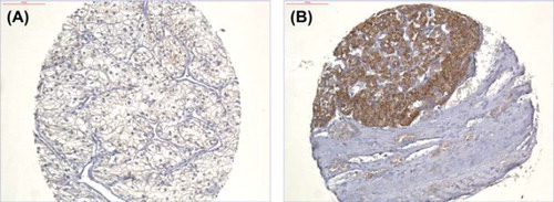 Figure 2. Parathyroid hormone-related protein expression in renal cell carcinoma. No (A) and strong (B) immunohistochemical expression of PTHrP (polyclonal guinea pig antibody T5045, Bachem, Switzerland), 20 × magnification.