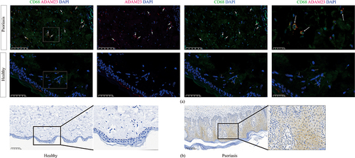 Figure 8 Immunohistochemistry and immunofluorescence showed that ADAM23 was elevated in psoriasis lesion skins. (a) Immunofluorescence for ADAM23 and CD68 in psoriasis tissues from human psoriasis lesion samples and healthy skin samples. (b) Immunohistochemistry for ADAM23 in psoriasis lesion skins and healthy skin tissues.