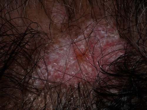 Figure 2 Scarring alopecia due to “burnt-out” discoid lupus erythematosus.Note: With permission from and courtesy of DermNet NZ.