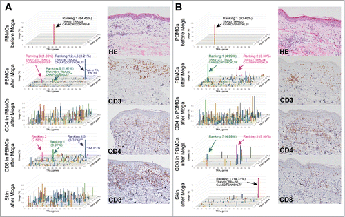 Figure 2. Peripheral blood T cells and cutaneous infiltrating T cells do not share the same major T cell clones after treatment with moga (A, B) PBMCs, sorted CD4+/CD8+ T cells, and skin tissues were subjected to TCR repertoire analysis in two ATL cases with moga-related skin rash. 3D graphs show the frequencies of TRAV/J clones. In panel A, the blue bar consists of three clones with different amino acid sequences in the CDR3 region, but sharing TRAV24/J52. H&E and CD3/4/8 staining of the samples of tissue from the skin rash are also shown. Data are representative of four independent patients.