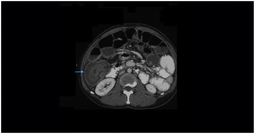 Figure 6f: Axial post-contrast CT showing a mass in the right iliac fossa (blue arrow) with alternating layers of low (mesenteric fat) and high attenuation (bowel wall) in keeping with ileocolic intussusception with SBO