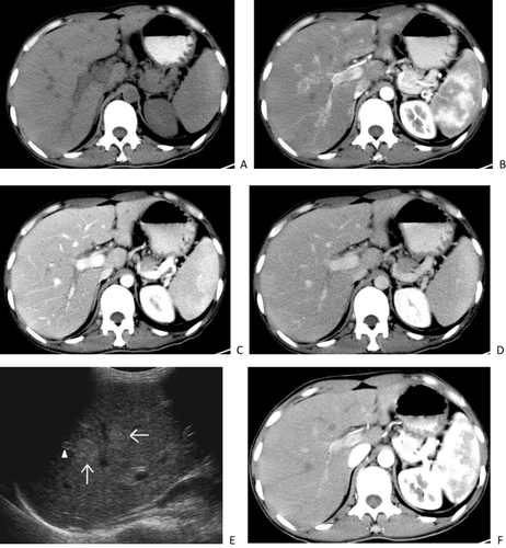 Figure 2 A 30-year-old man with AIDS-related hepatic Kaposi’s sarcoma. CT plain scan shows multiple low-density nodules in the liver (A). CT enhanced scan during the arterial phase showed circular enhancement of nodular lesions, mostly located around the portal vein and a few located under the hepatic capsule (B). The portal vein phase (C) and delayed phase (D) show gradual enhancement of the nodules, with equal or slightly lower enhancement. Ultrasound (E) showed multiple hyperechoic nodules (arrows) distributed along the portal vein in the liver, with thickening of the Glisson sheath and enhanced echogenicity (arrowhead). Two years later, the CT scan (F) Showed that the original intrahepatic nodules were not shown.