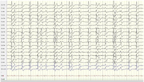 Figure 5. Initial EEG finding after the failure of hypothermia. Findings were consistent with GPEDs.