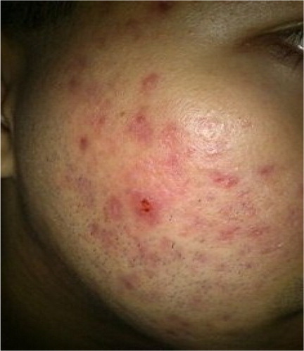 Figure 1. Common acne scars.