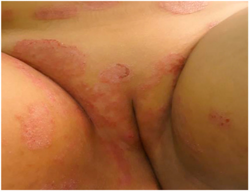 Figure 2 Sexually acquired genital dermatophytosis.