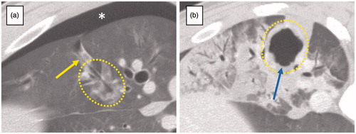 Figure 2. Complications. (a) Pneumothorax; Pneumothorax appeared immediately after the removal of the antenna (*). This lesion was ablated with short duration of energy delivery. Air-filled needle tract connecting to pleural space (yellow arrow) was also visible. (b) Cavitation within the ablation; cavitation (blue arrow) was seen on CT at 7 d after the treatment and was completely enclosed with the ablation. This lesion was ablated with long duration of energy delivery. Dotted lines demarcate the ablation zone from untreated lung.