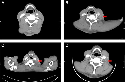 Figure 3 Cervical CT showed no lymphadenopathy before surgery (A); CT showed a significantly enlarged lymph node in the left neck which prompted PD after first-line chemotherapy (B); CT revealed the left cervical lymph node was not reduced after radiotherapy and irinotecan treatment (C); CT examination showed the swollen lymph nodes significantly narrowed and the border was not clear, suggesting that the patient achieved PR (D).