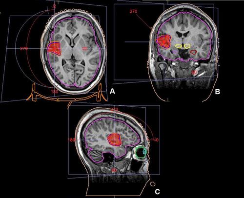Figure 5 Stereotactic radiosurgery plan for the right operculo-insular area in the coronal (A), axial (B) and sagittal (C) views.