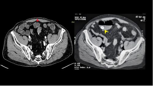 Figure 1 CT scan of the abdomen showing enterolith in a dilated small bowel segment (yellow arrowhead). Multiple small bowel diverticula are also seen (red arrowhead).