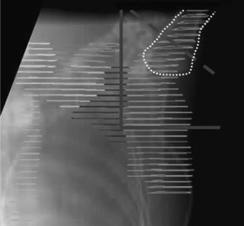 Figure 5.  The lateral field borders according to the 2D guidelines are shown with solid (>10 LN removed and <6 LN positive) and dashed (<10 LN removed or >6 LN positive) grey lines. The humeral head is shown with a dotted white line.