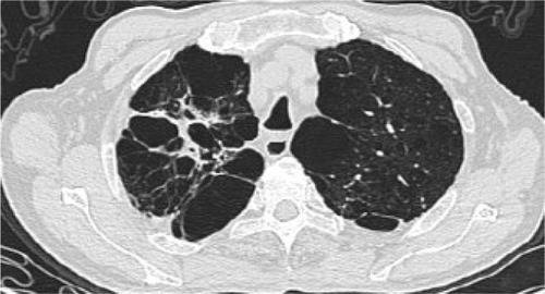 Figure 2 Similar emphysema at LUL and RUL in case 2 with TB sequelae in RUL (HRCT).Abbreviations: LUL, left upper lobe; RUL, right upper lobe; TB, tuberculosis; HRCT, high-resolution CT.
