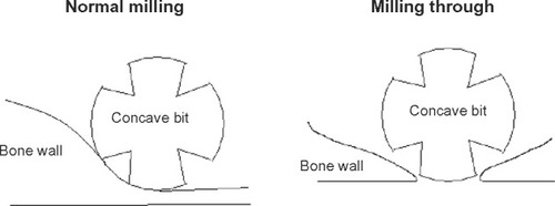 Figure 12 Sketch of the drill bit when it is milling through the bone wall.