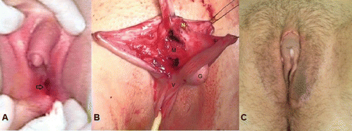 FIGURE 2. 46,XY gonadal (testicle) dysgenesis, incomplete form. (A) External genital view before operation. Clitoromegaly (appr. 5-6 sm), corresponds to Prader stage III-IV. The vagina introitus normal corresponds to Prader 0 (arrow).(B) The stage of clitororeduction: separated glans clitoris connected with dorsal (N) and ventral (V) neurovascular bundles; corpora cavernosa clitoridis (V). (C) The external genitalia after clitororeduction by recection of corpora cavernosa, in 3 week after operation.