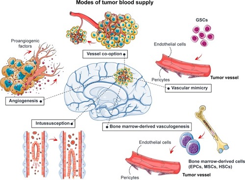 Figure 1 Angiogenesis and GB.Note: Five mechanisms are used to increase blood supply to the tumor: angiogenesis, vessel co-option, intussusception, vascular mimicry, and bone marrow-derived vasculogenesis.Abbreviations: EPCs, endothelial progenitor cells; GB, glioblastoma; GSCs, glioblastoma stem-like cells; HSCs, hematopoietic stem cells; MSCs, mesenchymal stem cells or mesenchymal stromal cells.