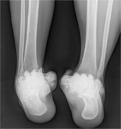 Figure 8 Varus malalignment of the hindfoot accompanied by chronic ankle instability.