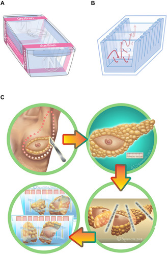 Figure 1 (A) Breast specimen (Pathum Raksa) container size 14×20×12cm with a cover locking system to prevent NBF leakage. (B) The acrylic barrier plates have at least 3 holes measuring in diameter of 0.5 cm, allowing NBF free flow between sections. (C) Breast tumor surgical specimens were serially cut to a thickness of 3 cm before being placed in the specialized container.