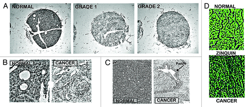 Figure 4. In situ staining of zinc levels in human pancreatic normal and adenocarcinoma tissues. (A) Low power tissue arrays showing marked decreased dithizone zinc staining in adenocarcinoma. (B) Enlargement to show the high zinc in the normal ductal and acini epithelium vs. zinc depletion in adenocarcinoma. (C) Shows the marked loss of zinc in PanIN and in the surrounding ductal adenocarcinoma. (D) Zinquin staining showing decreased zinc (loss of fluorescence) in adenocarcinoma.