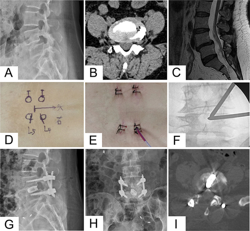 Figure 5 Perioperative imaging examinations, and intraoperative preparation in case 2. (A) Preoperative lateral DR showing the 4th lumbar developmental spondylolisthesis; (B) preoperative axial CT showing mild lumbar spinal stenosis; (C) preoperative sagittal MRI showing lumbar spondylolisthesis at L4-5 level; (D) photo image: the 4 circles on the skin represent the projection of the pedicle; the arrow points to the head end; the 2 short lines below the arrow are respectively the working portal and the endoscopic portal, and are also the entry points of pedicle screws; the 2 short lines above the arrow are the entry points of another two pedicle screws; (E) photo image: sutured skin incisions and 1 drainage catheter; (F) intraoperative fluoroscopy image showing 2 “pencil” guidance rods converged at the surgical target; (G–I) postoperative lateral and posteroanterior DR and sagittal CT after BE-TLIF.