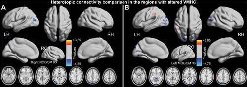 Figure 4 Significant group differences in the connectivity patterns (heterotopic connectivity) of the seed regions, with decreased VMHC being observed in the right MOG/pMTG (A) and the left MOG/pMTG (B) (P<0.01, GRF-corrected at a cluster level of P<0.05).