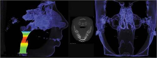 Figure 6. Image on the upper airway dimensions and respective boundaries.