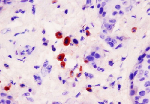 Figure 4.  Thrombospondin (TSP)-positive macrophages adjacent to tumour cells (×400).