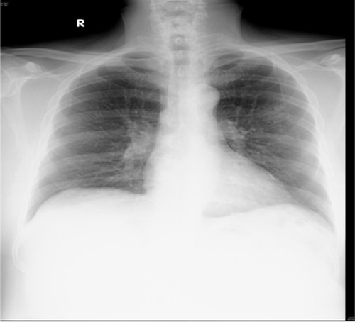 Figure 1 Nodular opacities in left upper zone periphery on chest X-ray (posteroanterior view).