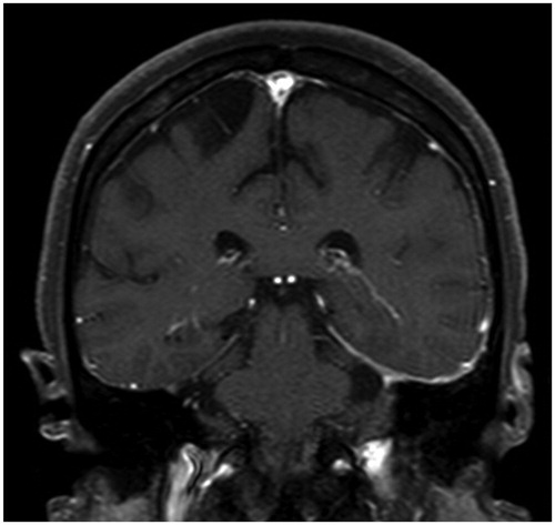 Figure 3. Contrast enhanced T1-weighted MRI showing enhancement of the dura beneath the left temporal lobe, compatible to hypertrophic pachymeningitis.