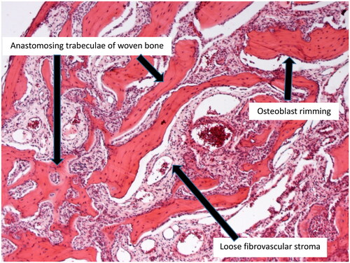 Figure 3. Osteoid osteoma formed of anastomosing trabeculae of woven bone with osteoblast rimming and intervening loose fibrovascular stroma (H&E-stained slide, x50 magnification).