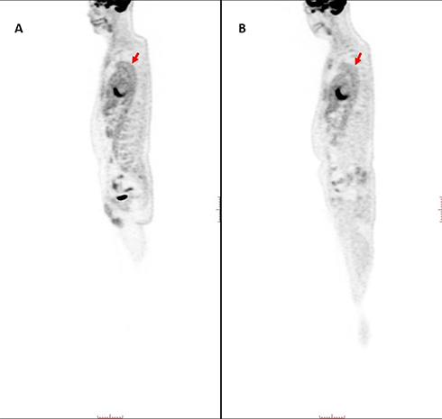 Figure 2 A DLBCL case with COVID-19 imaged by 18F-FDG PET/CT examination prior to and after infection. (A) Sagittal PET images after infection and (B) before infection by SARS-CoV-2 in a 55-year-old male patient with DLBCL. Red arrows indicate diffuse increased 18F-FDG uptake on the aortic wall area after COVID-19 infection.