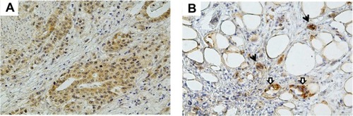 Figure 1 Representative images of vascular endothelial growth factor immunostaining in gastric cancer tissues. (A) Diffusely stained cytoplasm of cancer cells in primary tumor. (B) Strongly stained cytoplasm of cancer cells (black arrow) and fibroblasts (white arrow) in peritoneal tumor.