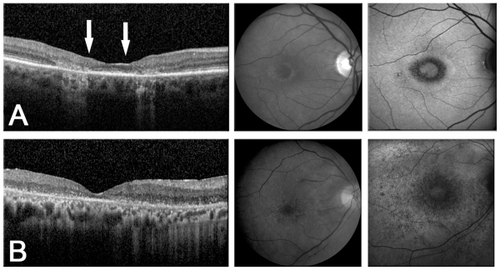 Figure 4 Spectral domain optical coherence tomography (SD OCT) images, red-free photos, and fundus autofluorescence (FAF) demonstrate a spectrum of findings seen with different stages of hydroxychloroquine retinopathy. Note the increased signal of choroidal vessels on SD OCT as the retina becomes increasingly atrophic with progressive toxicity starting from early toxicity in patient 10 seen in Figure 3. A) Moderate toxicity. Patient 24: vision loss, clinical bull’s eye maculopathy even more apparent on FAF, Humphrey visual field (HVF) 10-2 paracentral scotomas, and significant perifoveal outer retinal dropout but preservation of central photoreceptor inner segment/outer segment junction (between the arrows) seen on SD OCT allowing 20/40 vision. B) Late toxicity. Patient 18: severe vision loss to hand motion, pronounced clinical and FAF bull’s eye maculopathy, dense HVF 10-2 paracentral scotomas, and complete disruption of outer retinal structures on SD OCT.