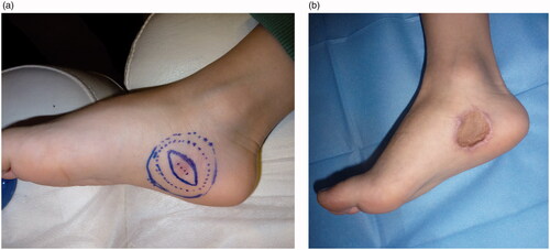 Figure 3. Preoperative view and design of the excision with 2 cm margins (A). Early postoperative result after skin graft coverage of the defect (B).