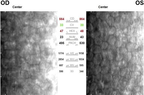 Figure 4 Specular endothelial cell density at 7 months postop.