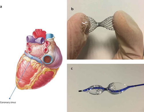 Figure 1. A: Diaphragmatic face of the heart. In evidence the coronary sinus. B: The typical hourglass shape of coronary sinus Reducer; C: Coronary sinus reducer mounted on the delivery balloon.