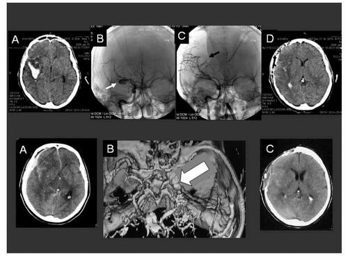 Figure 1 Upper sequence: SAH in a 48 year-old patient, H&H 4; (A) Preoperative CT-scan showing a right temporal mass occupying bleeding and secondary brain swelling; (B) Preoperative antero-posterior cerebral angiography of the right internal carotid artery demonstrating a multilobular giant aneurysm on the middle cerebral artery (white arrow) with vascular displacement; (C) Postoperative angiographic control showing a complete aneurysm occlusion and the borders of the decompressive craniotomy (black arrow); (D) Postoperative CT-scan demonstrating the clot-removal and the surgical decompression. Lower sequence: Fifty nine year-old woman with massive subdural and SAH and clinical herniation signs, H&H 5; A) Preoperative CT-scan demonstrating the right hemispheric subdural hemorrhage and the acute brain shift of the midline structures; (B) CT-angiography displaying the aneurysm (arrow) arising from the internal carotid artery; (C) Postoperative CT-scan demonstrating the brain reexpansion the surgical decompression.