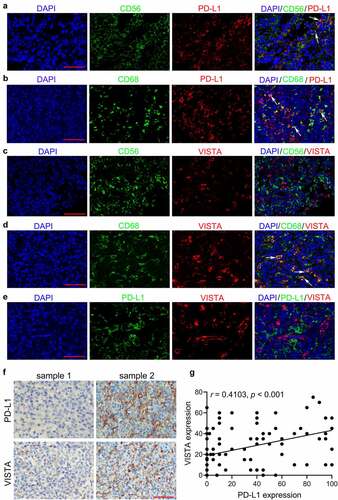 Figure 1. Expression of PD-L1 and VISTA in tumor tissues from ENKTCL patients. A-E. Representative double immunofluorescence images of CD56 (green) and PD-L1 (red) (a), CD68 (green) and PD-L1 (red) (b), CD56 (green) and VISTA (red) (c), CD68 (green) and VISTA (red) (d), and PD-L1 (green) and VISTA (red) (e). The nucleus is labeled with DAPI (blue). Arrows indicate the colocation of indicated proteins. F. The representative IHC images of PD-L1 and VISTA from serial sections. G. The correlation between PD-L1 expression and VISTA expression depicted with scatter plot. Scale bar is 50 μm