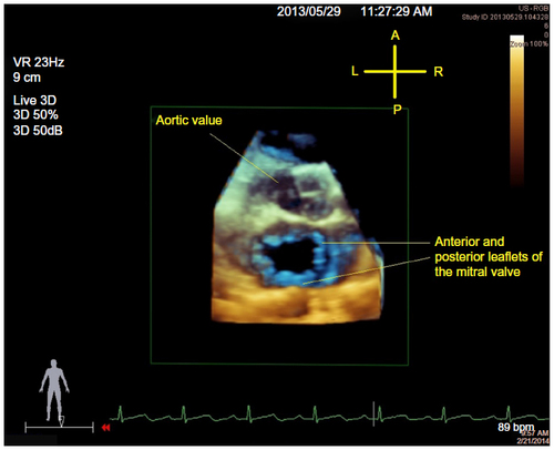 Figure 1 View of the MV in ventricular diastole from the left atrium, or the so-called surgeon’s view.