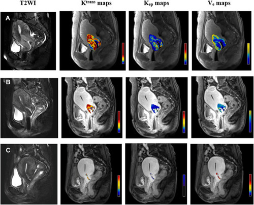 Figure 3 Dynamic changes of DCE-MRI parameters in a responder. Images in each row are representative images from three different timepoints (A=pre-RT; B=mid-RT; C=post-RT) from a 68-year old patient with IIB disease. The images of the primary tumor from T2WI are presented to show volume changes in mid- and post-RT in comparison with the baseline. Corresponding kinetic parameters (Ktrans, Kep, and Ve maps) of the primary tumor are presented to show permeability changes from the three given timepoints (Pre-, mid-, and post-RT). Ktrans in pre-, mid-, and post-RT were 1.157 min−1, 1.978 min−1, and 0.367 min−1, respectively; Kep in pre-, mid-, and post-RT were 3.302 min−1, 3.713 min−1, and 0.482 min−1, respectively; Ve in pre-, mid-, and post-RT were 0.411, 0.577, and 0.763, respectively. This patient achieved a complete response after the treatment.