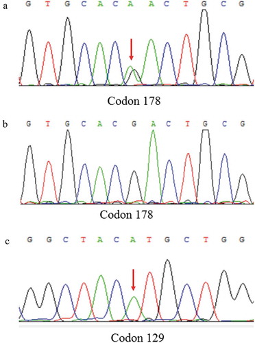 Figure 3. DNA sequence at codon 178 of PRNP gene from the patient (A) and a normal case (B). The red arrow indicates the c.532G > A mutation causing a substitution of GAC (asparagine) by AAC (aspartic) at codon 178 of the protein. DNA sequence at codon 129 of PRNP gene from the patient (C) shows Met at codon 129 of the PRNP gene.