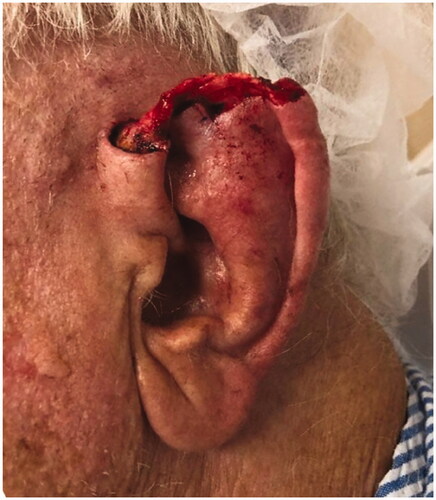 Figure 1. Patient initially presented with 4.2 × 2.5 cm (10.5 cm2) auricular skin defect of the superior helix and superior crus of the scapha that extends posteriorly into the superior retro-auricular sulcus after Mohs micrographic surgery excision of a basal cell carcinoma.