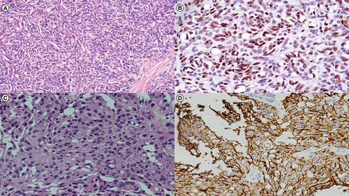 Figure 1. Histopathological findings of hemangioendothelioma.(A) H&E image in 100x magnification showing representative photomicrograph of the case of Kaposiform hemangioendothelioma with cannonball pattern of arrangement and slit like vascular spaces lined by mildly pleomorphic endothelial cells. There is no significant atypia and no mitotic figures. (B) Immunostain for FLI-1 showing nuclear positivity in the endothelial cells. (C) H&E image in 200x magnification showing representative photomicrograph from a case of epithelioid hemangioendothelioma with cells with epithelioid morphology showing mild to moderate pleomorphism with abundant eosinophilic cytoplasm. Many cells show presence of intracytoplasmic lumina characteristic of endothelial cells. (D) Immunostain for CD31 antigen showing membrano-cytoplasmic positivity in endothelial cells.
