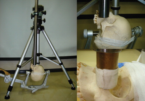 Figure 2.  The experimental device used for the actual study. (Left) Each skull is fixed and placed under a stainless steel pipe. (Right above) The pipe is placed so that its lower end matches the inferior orbital rim. (Right below) The brass weight slides inside the pipe and strikes the inferior orbital rim.